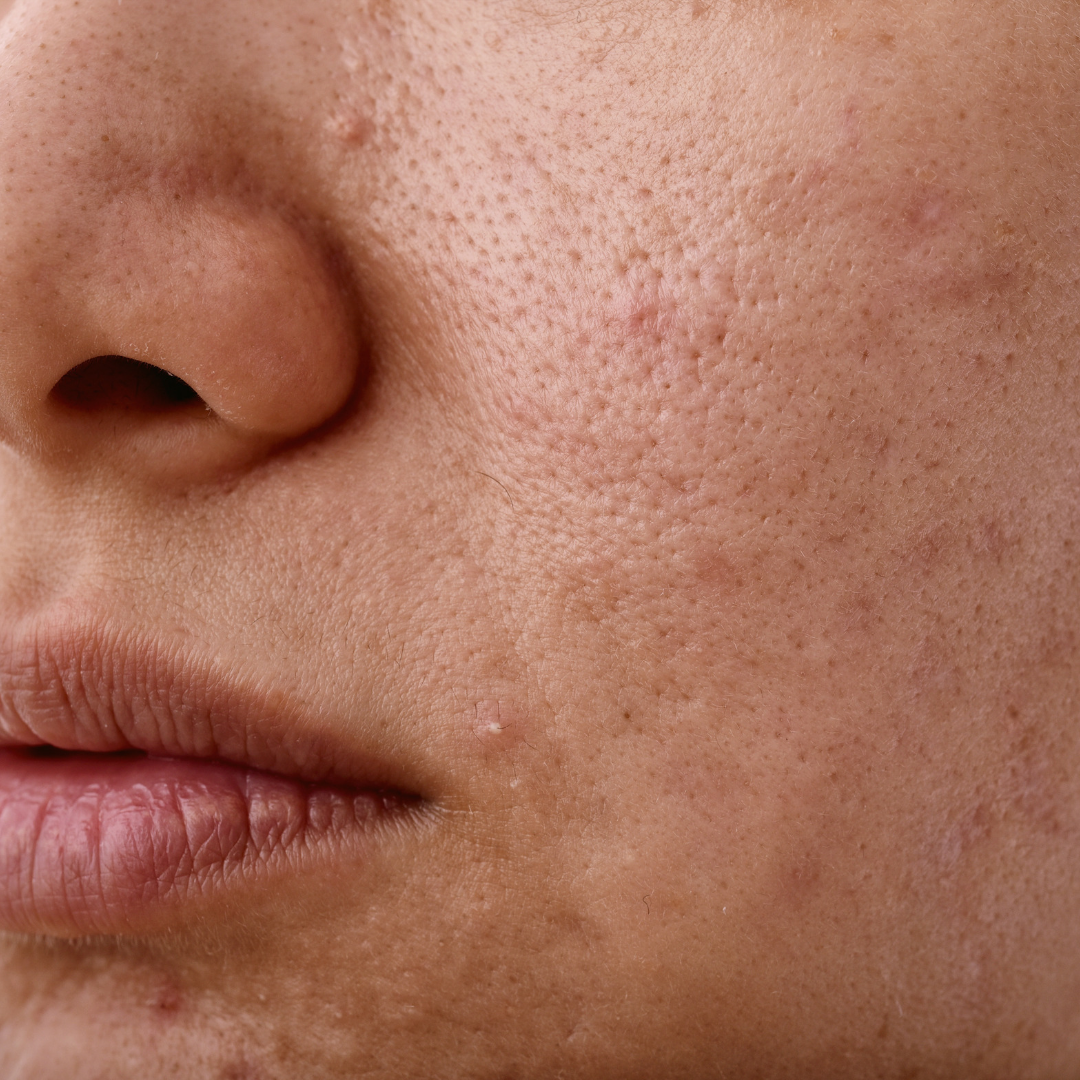 peau-imperfections
